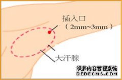 大连狐臭患者可以吃有刺激性气味的食物吗