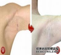 大连青岛医院如何治疗腋下狐臭