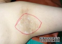 大连怎么治疗腋下狐臭效果好