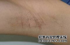 大连腋臭是由什么原因引起的