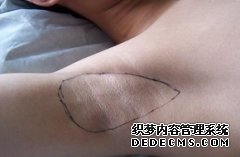 大连腋臭应该如何护理