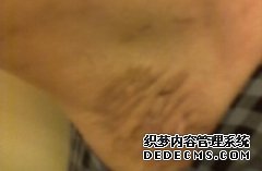 大连腋臭会患者造成什么样的危害