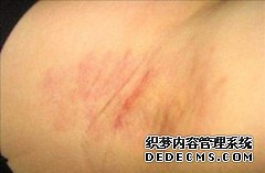 大连青岛哪家医院能治腋臭 腋臭都有什么治疗方