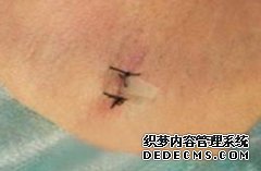 大连李村女性腋臭很严重选择哪种方式治疗好呢