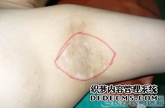 大连市北女性腋臭手术之前要注意哪些问题呢